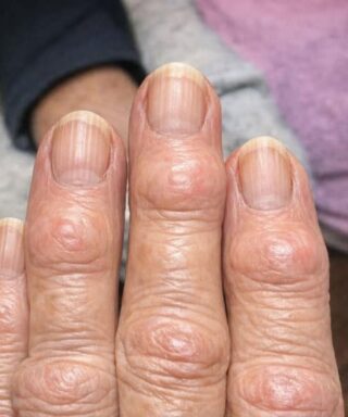 My grandma has these hard bumps forming on her finger joints near the nails. Why is this spreading?