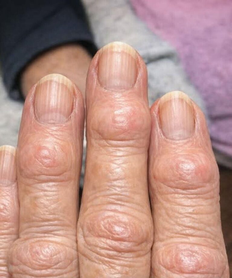 My grandma has these hard bumps forming on her finger joints near the nails. Why is this spreading?