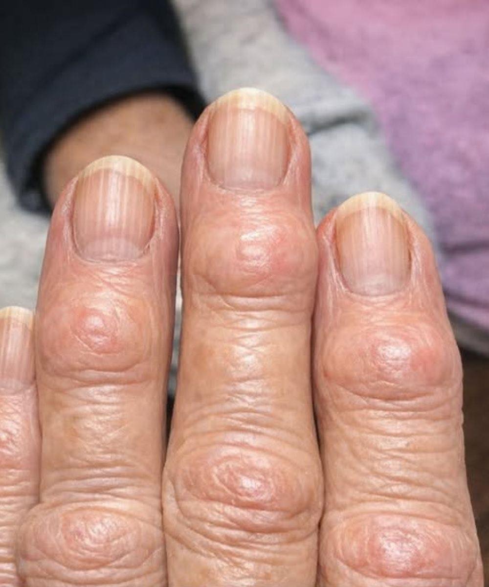 My grandma has these hard bumps forming on her finger joints near the nails. Why is this spreading?